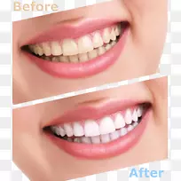 牙齿美白人牙齿美容牙科.清洁牙齿的比较
