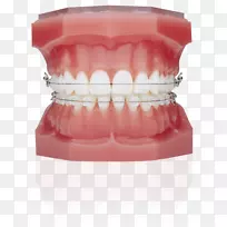 牙托，正畸，舌牙套，牙科学.牙套