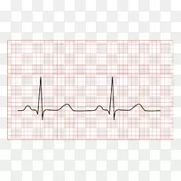 心电图心脏QRs复合窦性心律窦房结条