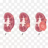 肾肿瘤肾切除肾细胞癌解剖-肾