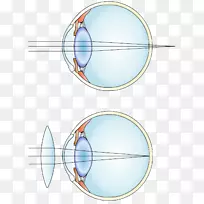 近视、远视、矫正性晶状体散光屈光手术.视力