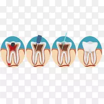 牙髓治疗根管牙髓牙科-牙科