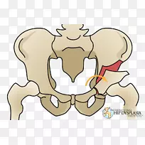 截骨术髋关节发育不良髋臼股骨骨