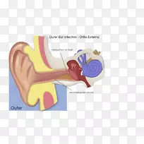 中耳炎前庭神经鞘瘤内耳