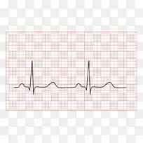 心电图QRs复合药物心脏病心电图