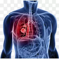 肺癌症状转移-癌细胞体