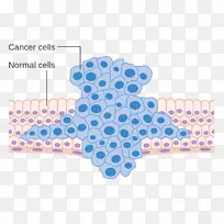 癌细胞转移瘤-各种癌细胞