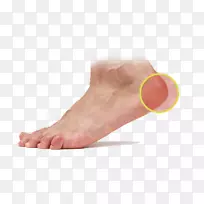 足底皮肤足底筋膜炎