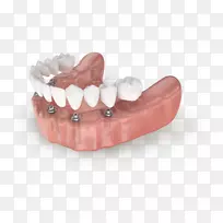 牙全对4牙种植牙科牙本质-种植牙