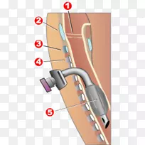 气管切开术气管甲状腺软骨环状软骨