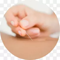 体外受精针刺生育临床不孕症治疗针刺
