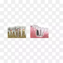 义齿修复学牙科种植牙健康