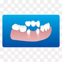 牙科牙种植体根管-牙科诊所卡