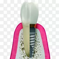 牙科种植体牙科手术.植入物