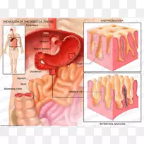 粘膜解剖消化胃肠病胃食管反流病