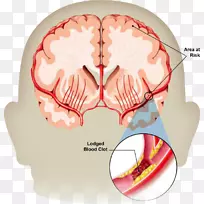 脑卒中短暂性脑缺血发作神经病学脑出血健康
