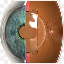 Phakic人工晶状体植入角膜磨镶镜LASIK视力-眼睛
