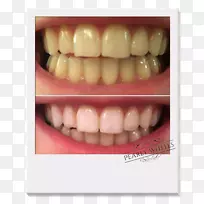 牙齿美白-人类牙齿