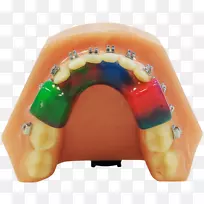 双牙体矫治器正畸固位正畸技术