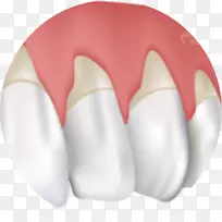 牙龈退缩牙龈炎牙周病治疗-健康