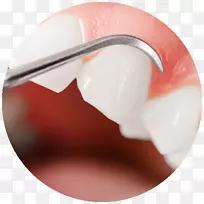 牙龈疾病，牙龈移植物肿胀性牙龈炎-健康