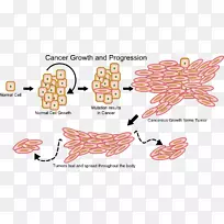 癌细胞生长瘤-肿瘤