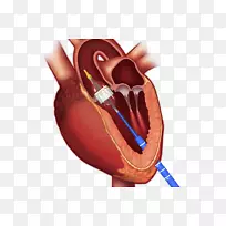 经皮主动脉瓣置换术-心脏