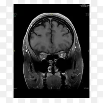 颅骨医学X线摄影CT医学脑-颅骨