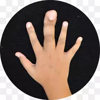 拇指局部巨人手趾手