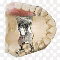 牙科假牙义齿.刻度和根刨