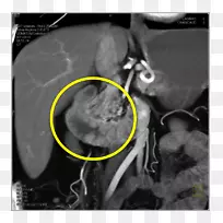 CT检查息肉十二指肠大肠