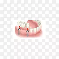 牙科种植牙桥义齿.桥
