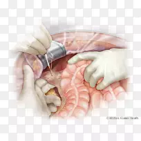 结肠弯曲，升结肠，肝性韧带，结肠切除术，肠系膜
