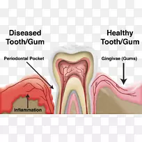 牙周病牙龈.健康