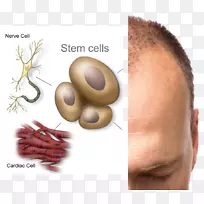 干细胞治疗疾病脐血库脱发