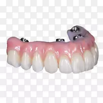 牙全对4义齿桥牙种植体桥