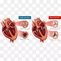 主动脉瓣狭窄主动脉瓣置换术心脏瓣膜病球囊瓣膜成形术.理想重量的计算