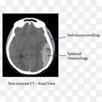 脑硬膜外血肿-脑出血的计算机断层扫描