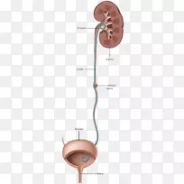 输尿管支架置入术排泄系统肾结石