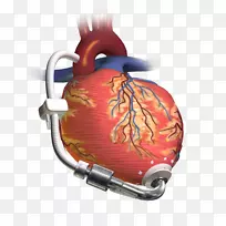心室辅助装置心脏移植人工心室-左心室