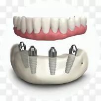 牙齿假牙、牙种植体、牙科