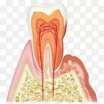 牙周病牙龈-牙龈