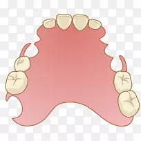 牙科义齿可摘局部义齿