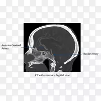 Willis矢状面脑动脉瘤-脑CT环的研究