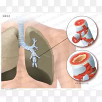 急性支气管炎哮喘肺毛细支气管炎支气管-支气管