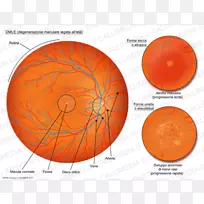 老年性黄斑变性黄斑萎缩眼