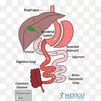 十二指肠开关胃旁路手术减肥手术袖状胃切除术十二指肠开关