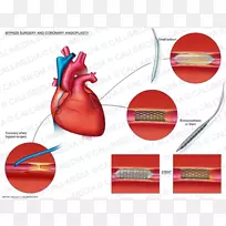血管成形术心脏冠状动脉旁路手术支架置入术-心脏