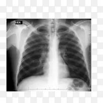 X线放射学X线摄影肋骨医学影像