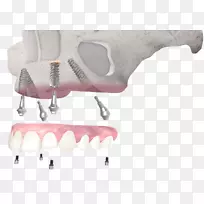 牙种植体牙科全4骨整合